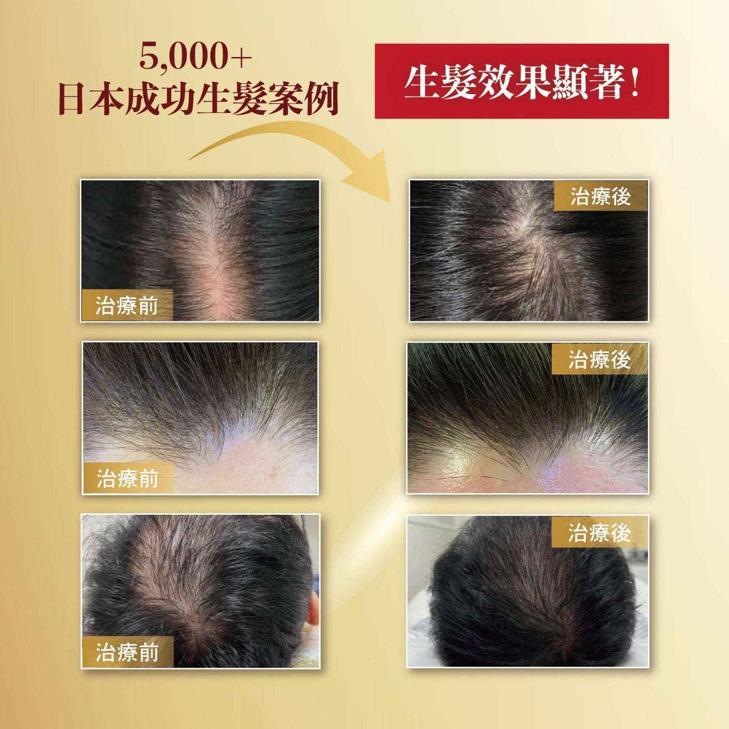 KAMI HAKKEN 髪発見 3個月育髮套裝